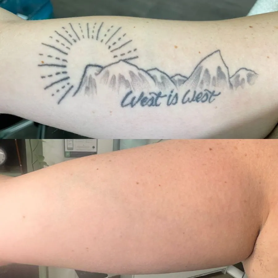 A person's arm with a tattoo of a mountain range, a sun, and the words "Wast is Wast" on it. The second image shows the same arm without the tattoo.