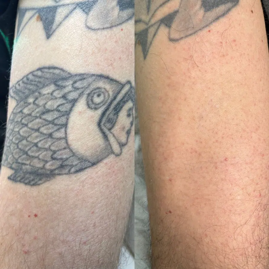 Close-up of a person's arm showing a tattoo of a fish with scales, an eye, and an open mouth. The right side of the image shows the same arm after tattoo removal, with faded ink and red spots where the tattoo was.