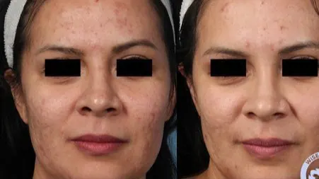 Acne scars