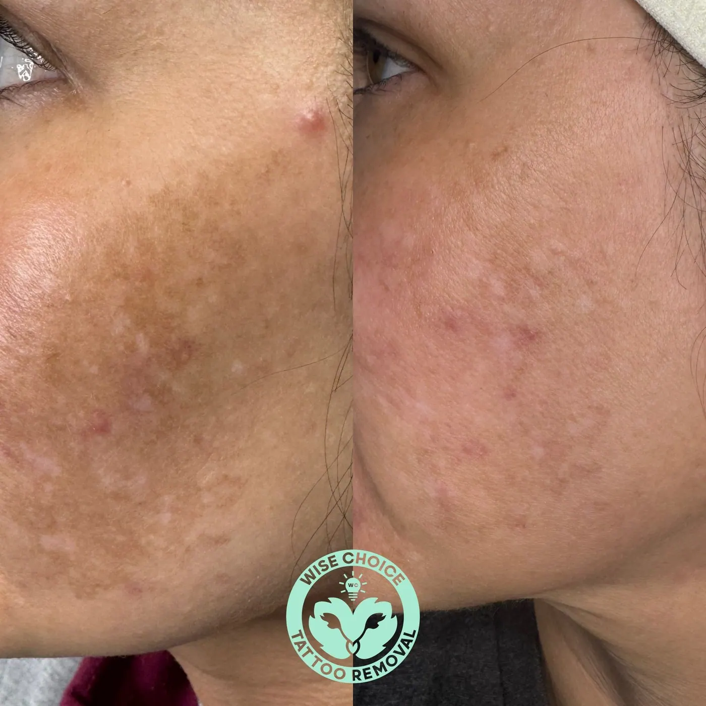 Comparison of facial skin before and after tattoo removal, showing reduction in pigmentation and scarring.