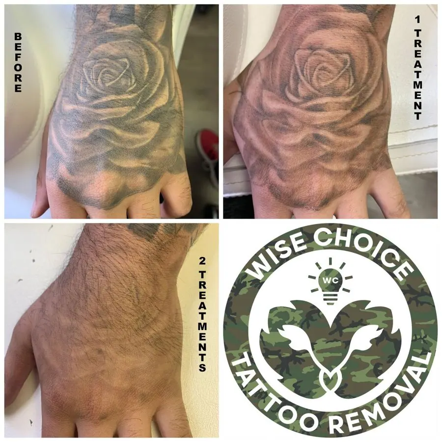 The image shows a collage of three photos of a person's hand and wrist with a tattoo and a circular logo. The first photo, labeled 'BEFORE,' depicts a tattoo of a rose on the top of the hand. The second photo, labeled '1 TREATMENT,' shows the same ha
