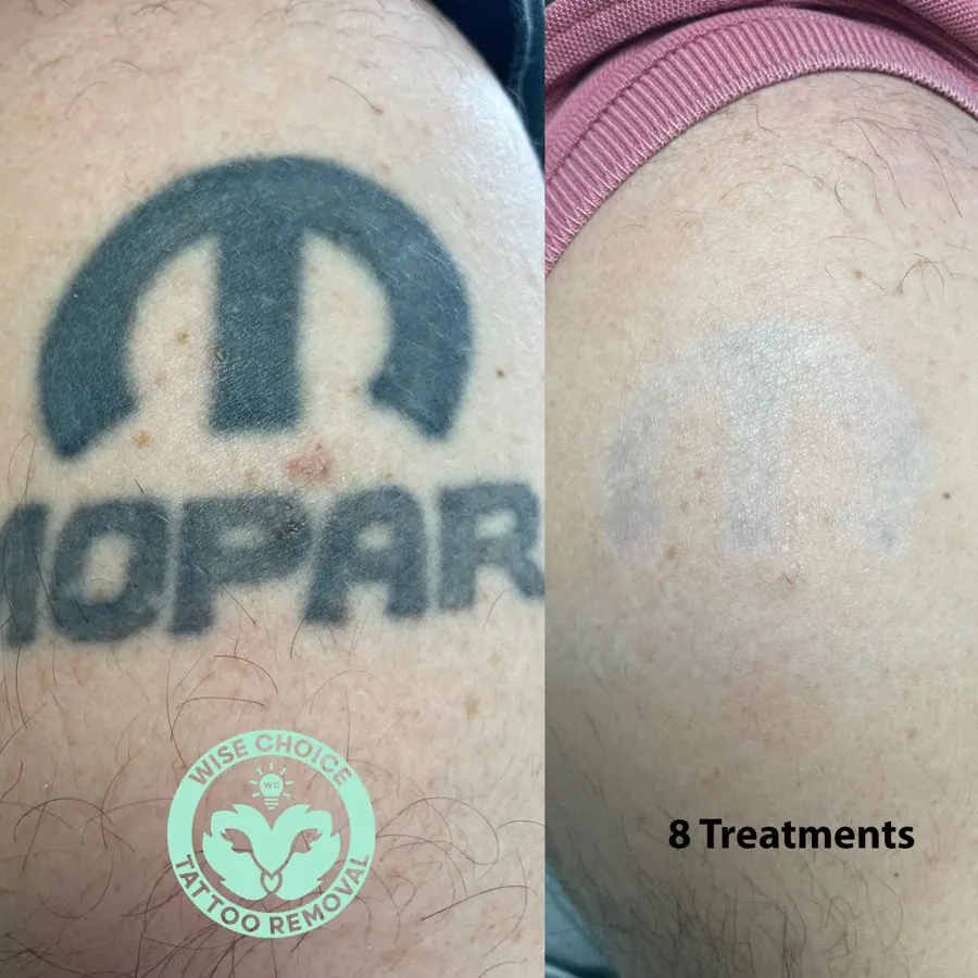 Close-up of a person's skin showing a tattooed Peace symbol and the word "OPAR," with the logo of WISE CHOICE TATTOO REMOVAL and text indicating 8 treatments for tattoo removal.