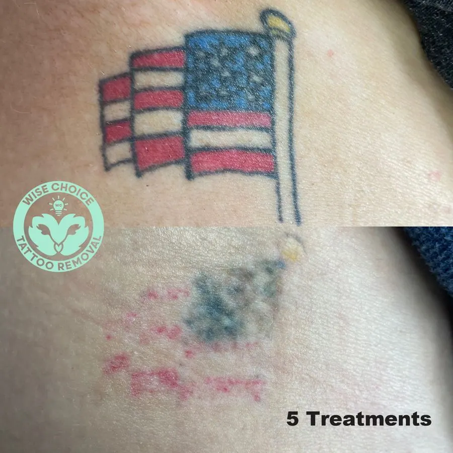 Tattoo of an American flag on skin showing fade and redness after five tattoo removal treatments.