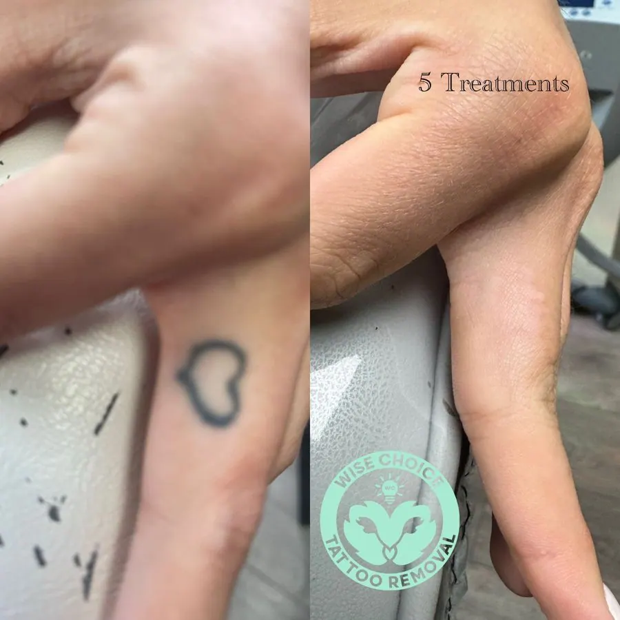 Before and after images showing tattoo removal on a finger, with text indicating 5 treatments and a logo of a tattoo removal service.