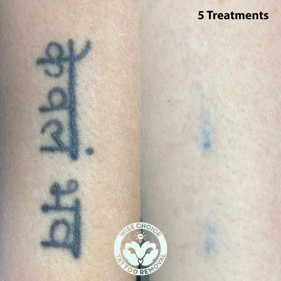 Comparison of a tattoo before and after laser removal. The left side shows a black tattoo with the text 'lee line' in cursive, and the right side shows a faint, faded version of the tattoo after five treatments, with visible signs of laser removal. T