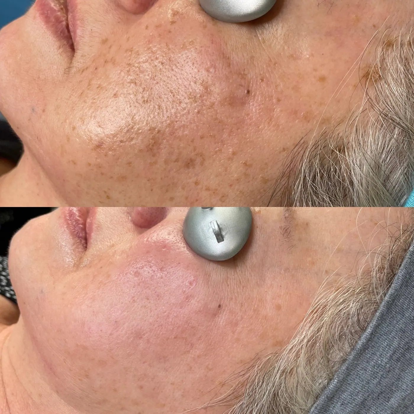Hyperpigmentation