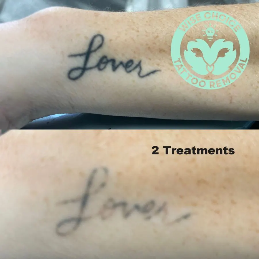 Close-up of a tattoo on a person's inner forearm with the word 'Love' in elegant cursive. Overlaid is a logo that reads 'Wise Choice Tattoo Removal' with a light blue background and a design with a light bulb and hands. Text on the image states '2 Tr