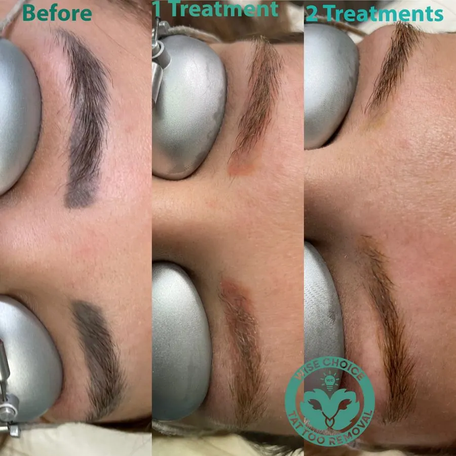 Sequence of three close-up images of a woman's eyebrow showing before, after first treatment, and after second treatment for tattoo removal. The 'before' shows a dark eyebrow tattoo, the 'after first treatment' shows the eyebrow fading, and the 'after second treatment' shows further fading of the tattoo.