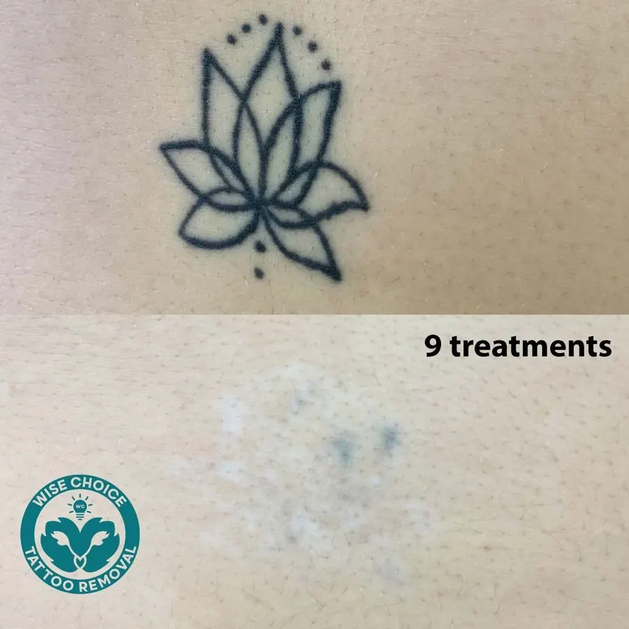 Comparison of tattoo before and after 9 treatments, showing tattoo removal progress, with WISE CHOICE tattoo removal logo.