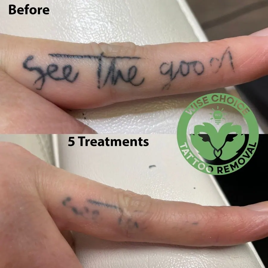 Before and after photos of a tattoo removal process showing a finger with a tattoo that says "See The good" and the same finger with the tattoo partially gone after five treatments, with a logo for Wise Choice Tattoo Removal.