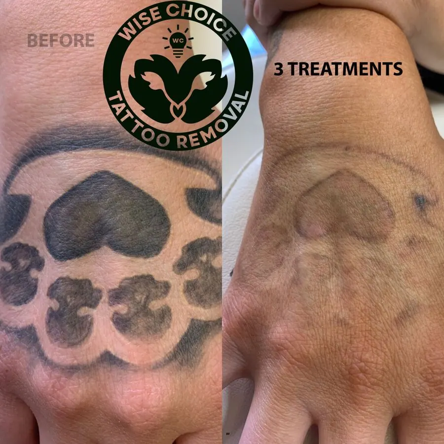 Close-up of a person's tattooed arm showing the before and after results of tattoo removal, with a logo for tattoo removal services.