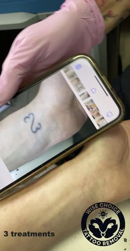 A person holding a smartphone with a photo of a wrist tattoo showing the a. There is a small circular logo at the bottom right corner that reads 'Wise Choice Tattoo Removal'. 