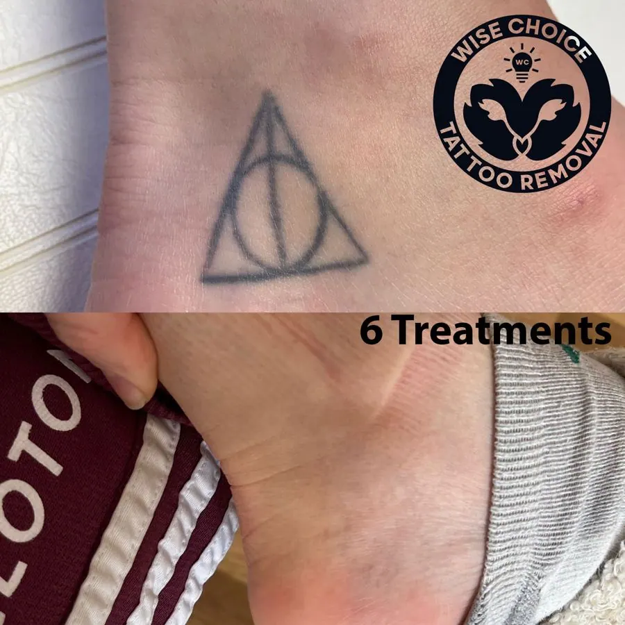 Close-up of a tattoo on skin featuring a circle within a triangle, with a line crossing through the circle. Text and graphics indicating tattoo removal treatments, including a black circle with the words 'Wise Choice Tattoo Removal' and a logo, along