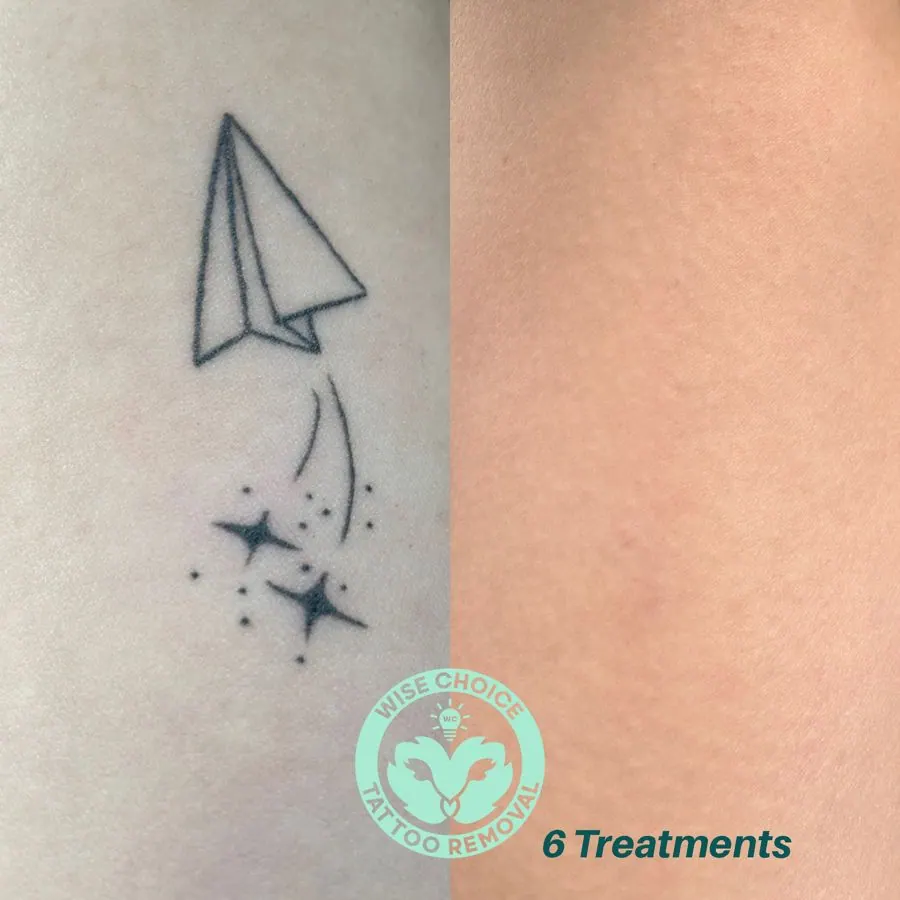 A tattoo of a paper airplane above stars and dots on skin, with a logo for Wise Choice Tattoo Removal and text indicating six treatments.