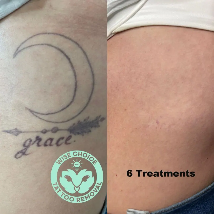 Comparison of tattoo removal process showing a tattoo of a moon, stars, and the word 'grace' on the left, and clear skin after six tattoo removal treatments on the right.