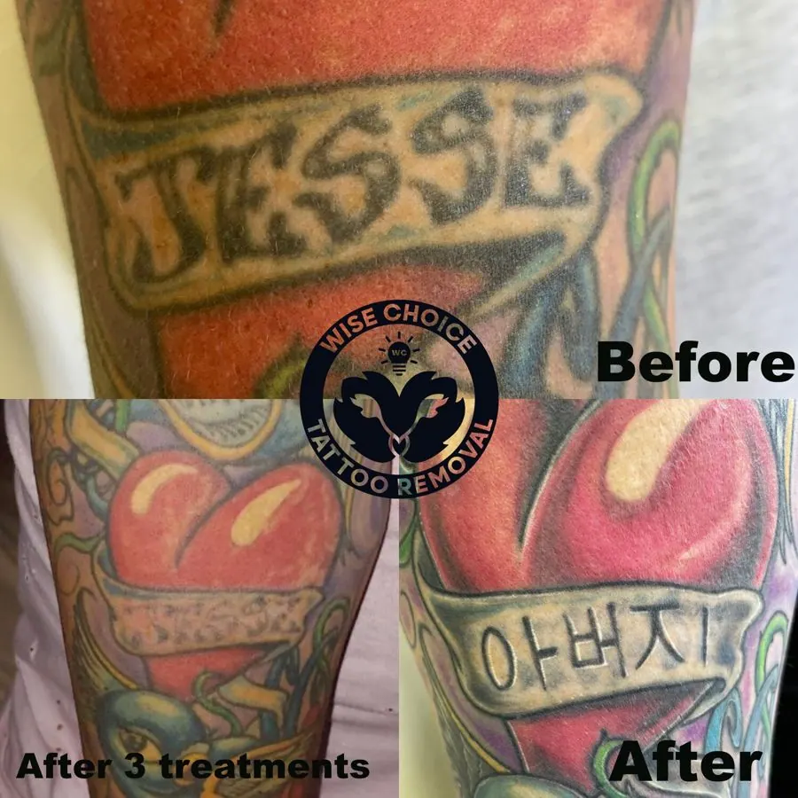 Comparison of a tattoo before and after tattoo removal treatments. The tattoo features a heart and text, with the top image labeled 'Before,' the bottom right labeled 'After,' and the bottom left labeled 'After 3 treatments.'