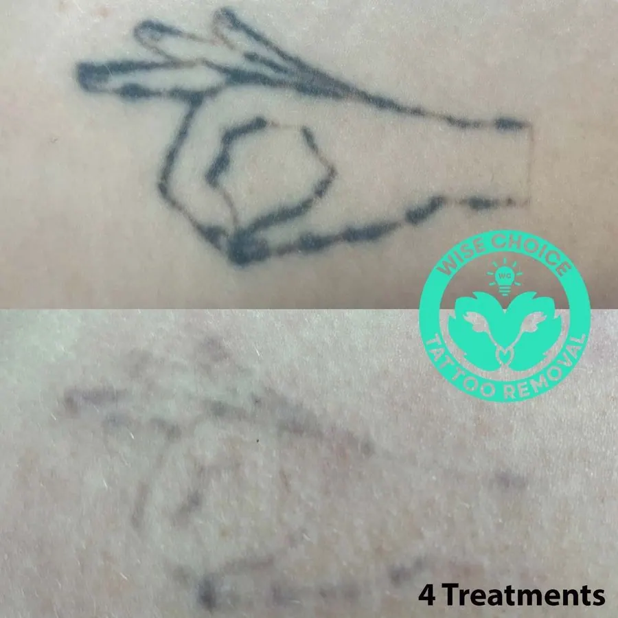 Comparison of tattoo before and after tattoo removal treatments, showing a hand making an OK gesture in the top image and a faded tattoo in the bottom image, with a watermark reading 'WISE CHOICE TATTOO REMOVAL' and text indicating four treatments.