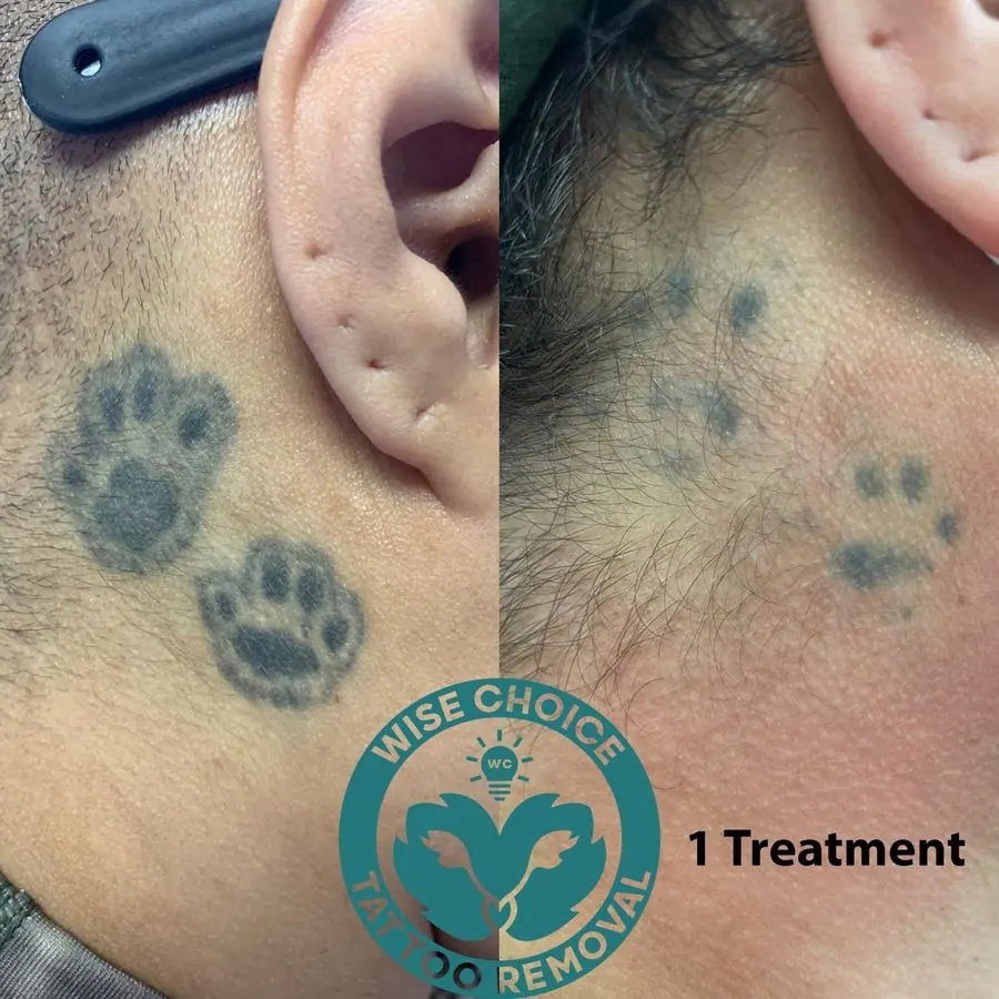Close-up of a person’s cheek with tattooed paw prints before and after tattoo removal treatment, showing fading of the tattoos.
