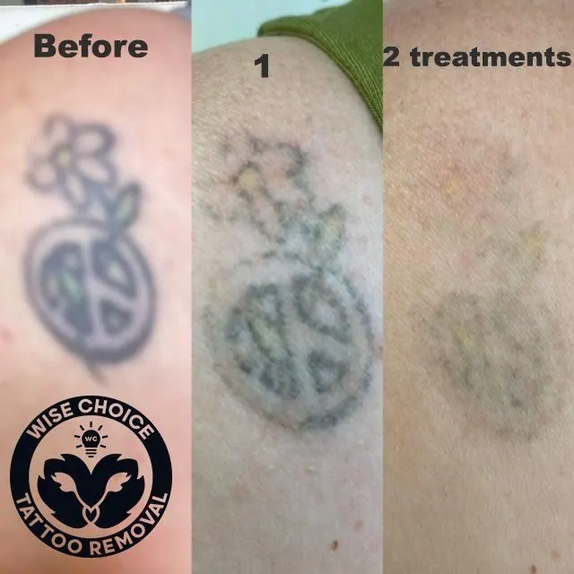Progression of tattoo removal: the tattoo initially is a colorful bike with a flower, then fades after one treatment, and nearly disappears after two treatments.
