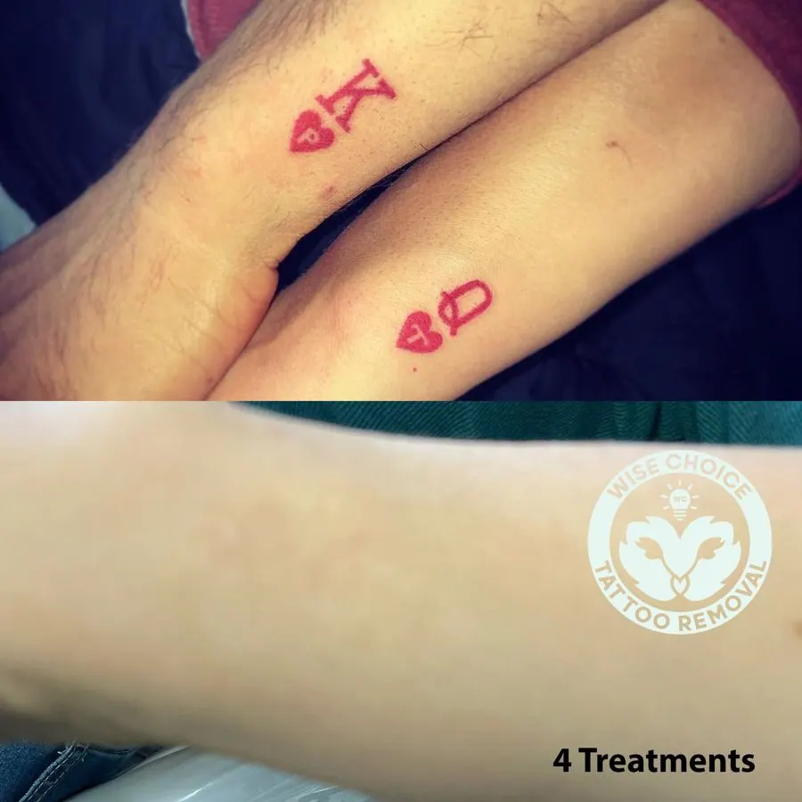 Two people's arms with red tattooed symbols and a logo on a person's arm promoting tattoo removal. The logo features a dove with the text "Wise Choice Tattoo Removal." The bottom right corner includes the text "4 Treatments."