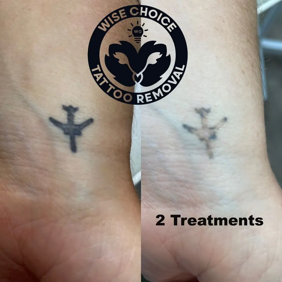 Side-by-side comparison of two tattoos on ankles, showing the results after two tattoo removal treatments.