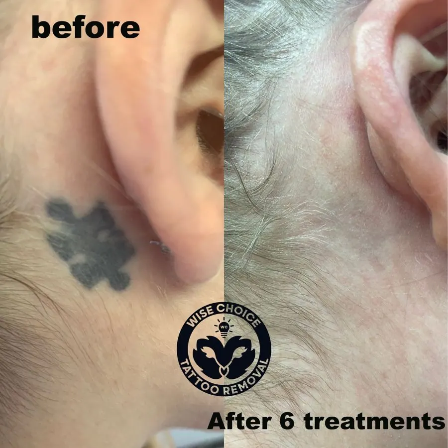 Close-up of a person's ear, showing a tattoo behind the ear on the left side, and the same area after six tattoo removal treatments on the right side, with significant fading of the tattoo.