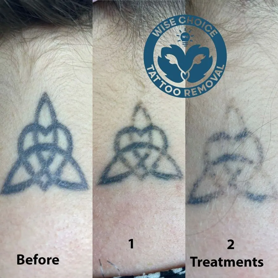 Three stages of tattoo removal process on a tattoo of a star with a heart in the center. The first image shows the original tattoo, the second shows a faded tattoo after one treatment, and the third shows a much lighter and more faded tattoo after mu