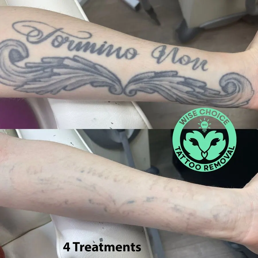 A person's forearm before and after four tattoo removal treatments. The upper part shows a tattoo reading 'Domino Moe' with decorative wings. The lower part shows the same area with faded remnants of the tattoo, indicating removal progress. There is 