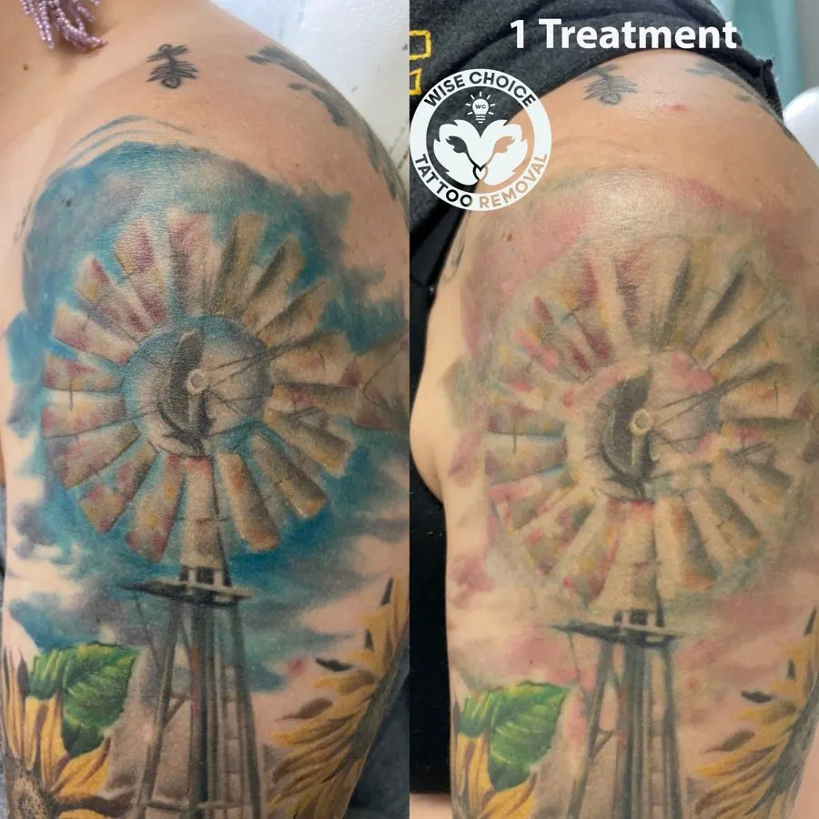 Before and after images of tattoo removal on a person's upper arm, featuring a tattoo of a watch with mountains, clouds, and leaves in a watercolor style.